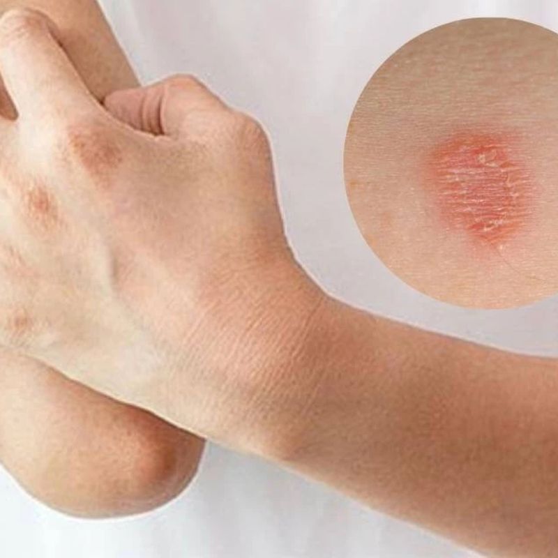 Triệu chứng bị nấm mèo ở người.