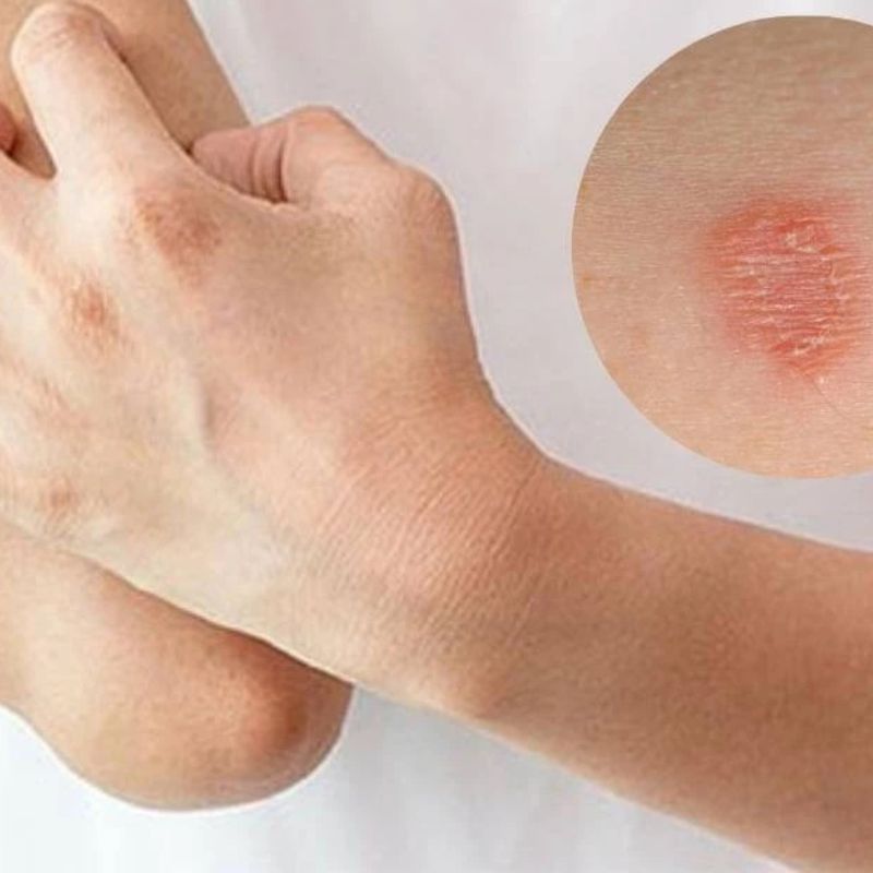 Mức độ nhiễm nấm ảnh hưởng tới hiệu quả của thuốc.