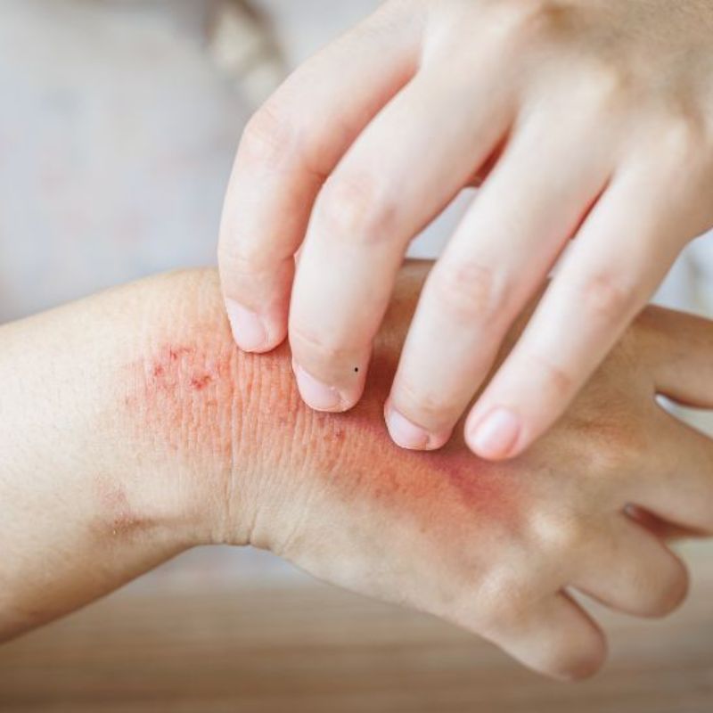 Các triệu chứng bị nấm mèo ở người.
