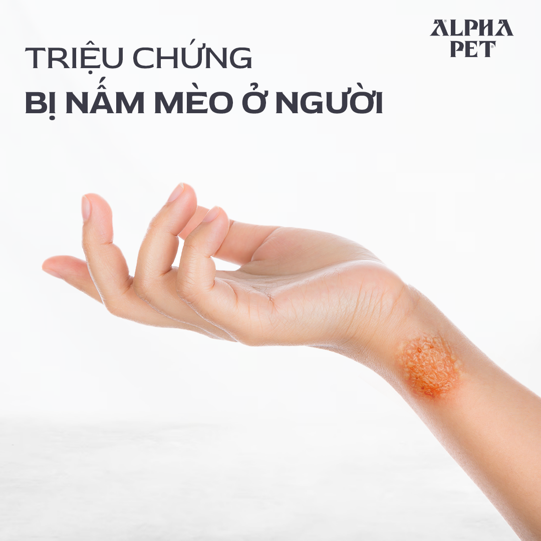 Tìm hiểu triệu chứng bị nấm mèo ở người.